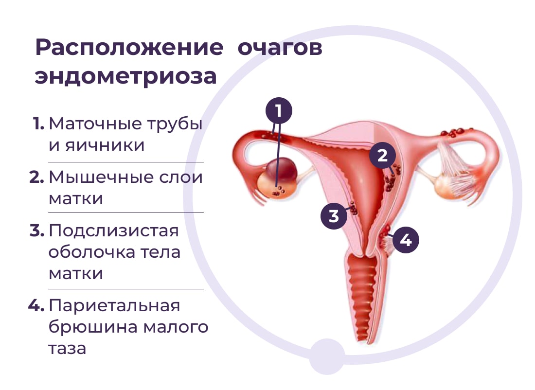 Эндометриоз и бесплодие фото 1