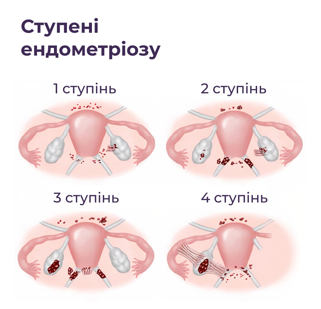 Лікування ендометріозу фото 1
