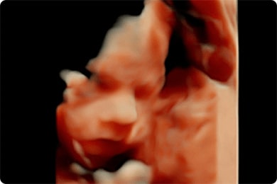 >Первая беременность в программе с использованием донорских яйцеклеток, суррогатного материнства.