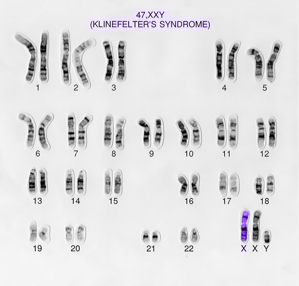 синдром клайнфельтера каріотип діагностика та лікування