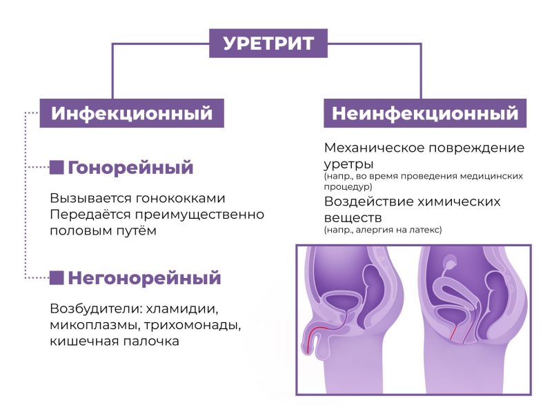 Виды уретрита