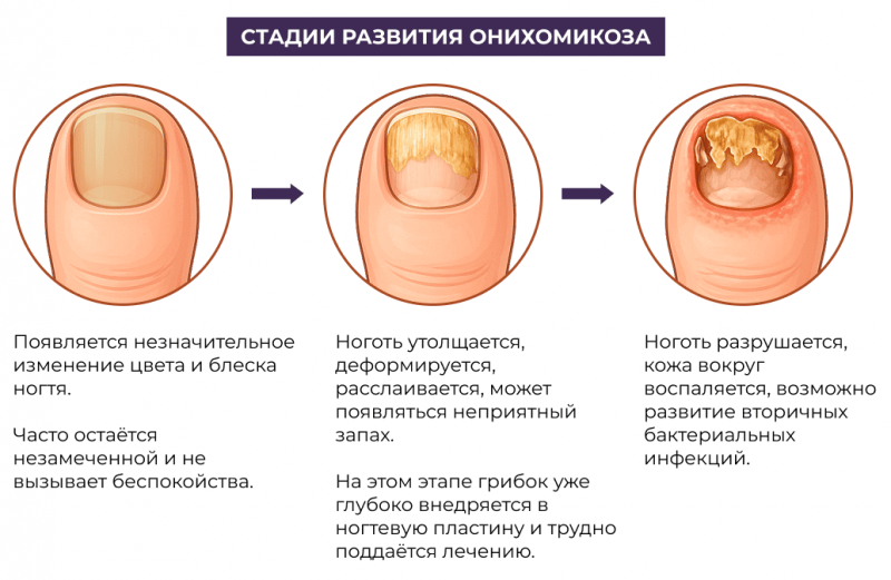 Стадии развития онихомикоза