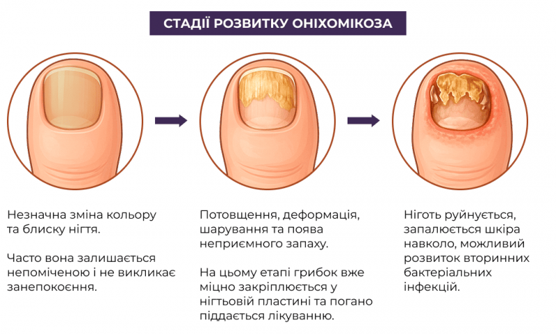 Стадії розвитку оніхомікоза