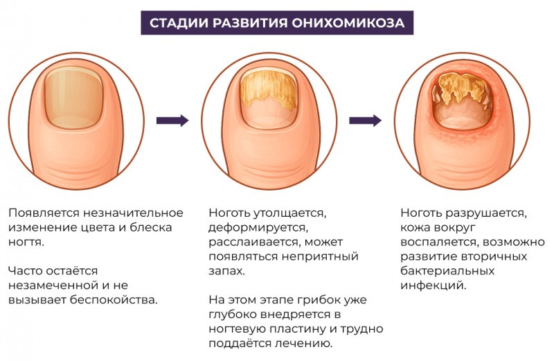 стадії онихомикоз